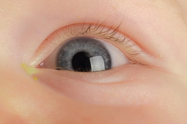 Розовый глаз (конъюнктивит) ) — стоковое фото
