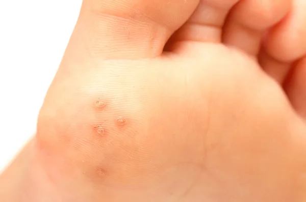 Closeup Plantar Warts Foot Child Caused Human Papillomavirus Hpv — Stock Photo, Image