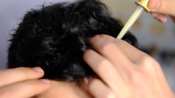 Léčba vypadávání vlasů — Stock video