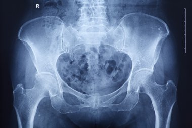 x - ray, omurga ve leğen kemiği