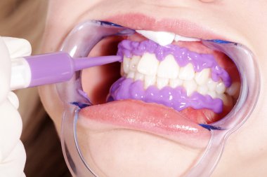 Kozmetik Diş Temizleme