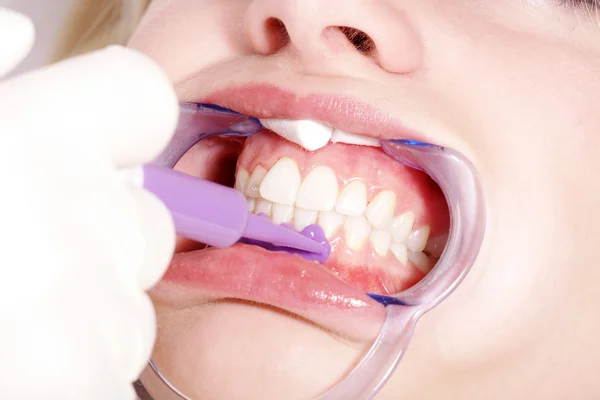 Limpieza dental cosmética — Foto de Stock