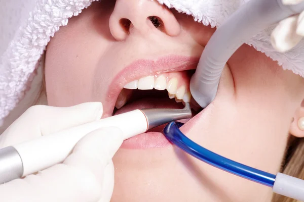 Limpieza dental cosmética —  Fotos de Stock