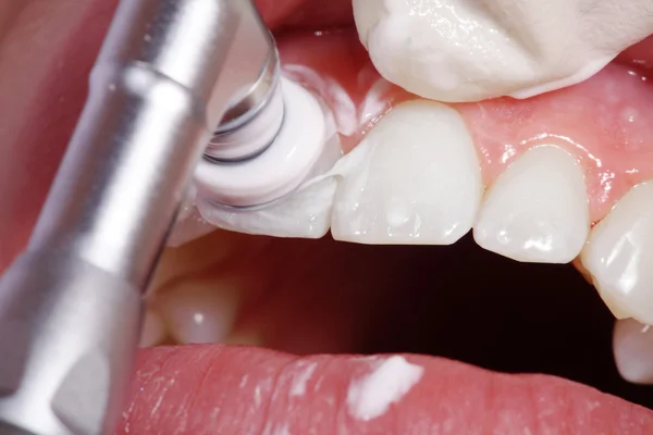 Nettoyage dentaire cosmétique — Photo