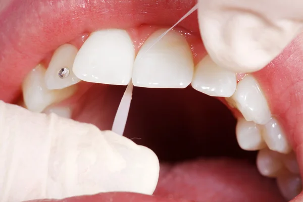 Kozmetik Diş Temizleme