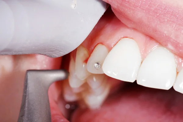 Косметическая чистка зубов — стоковое фото