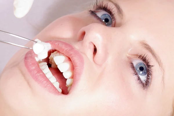 Limpieza dental cosmética — Foto de Stock