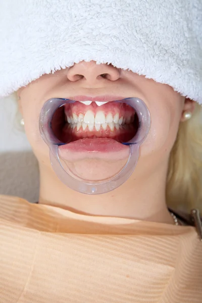 Cosmetic dental cleaning — Stock Photo, Image