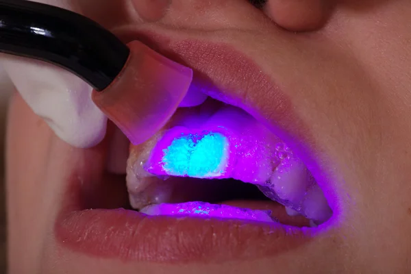 Kozmetik Diş Temizleme