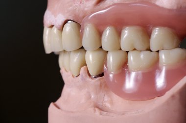 takma diş tedavi öncesi