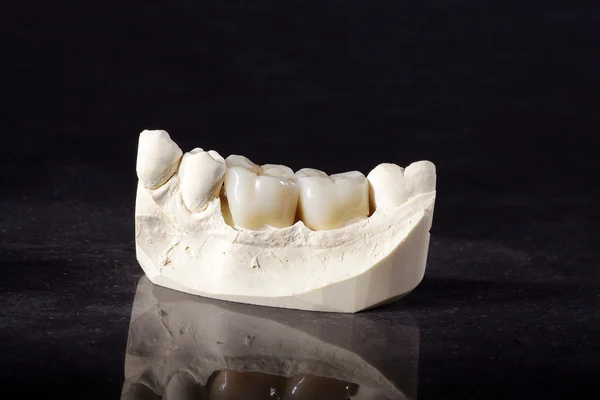 Dentition crown — Stock Photo, Image