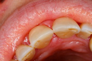 Kompozit dolgu diş tedavisi