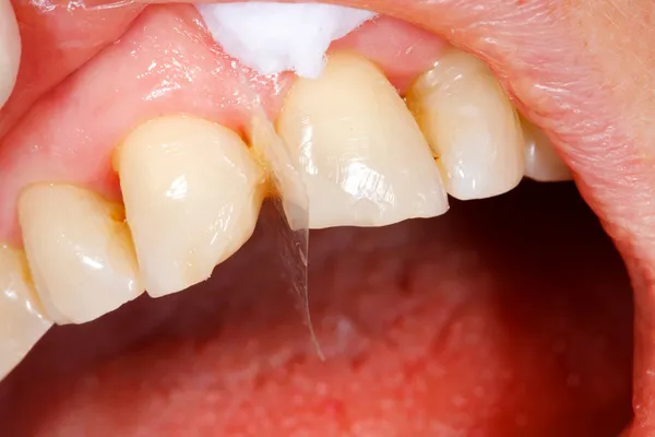 Trattamento dei denti di riempimento composito — Foto Stock