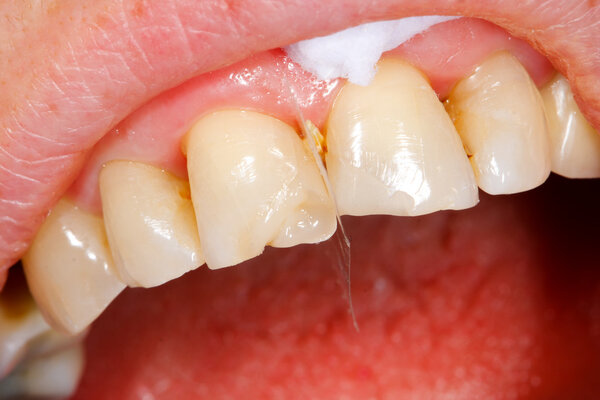 Composite filling tooth treatment