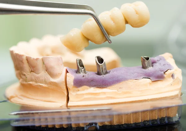 Testa e ponte per impianti dentali — Foto Stock