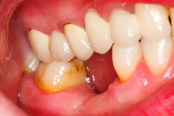 Een macro foto genomen van de bovenste en onderste kiezen is uitgevallen en premolars van een persoon — Stockfoto