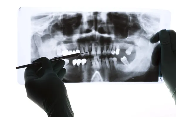 Крупный план панорамной рентгенографии, стоматолог держит ее в руке, указывая зондом — стоковое фото