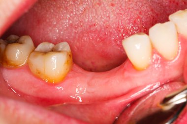 alınan alt azı dişleri ve premolars kısmi edentation olan bir kişinin bir makro fotoğraf.