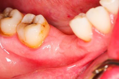 alınan alt azı dişleri ve premolars kısmi edentation olan bir kişinin bir makro fotoğraf.