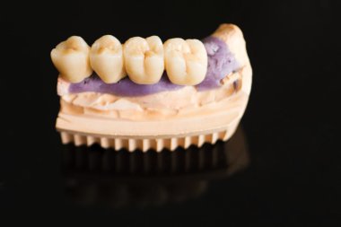 Dental bridge made of porcelain on casting clipart