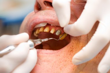 diş ipi dişeti sulkus yerleştirme