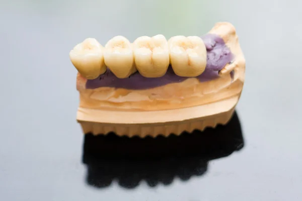 Dental bridge made of porcelain on casting — Stock Photo, Image