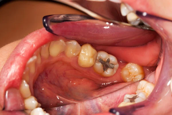 Fogászati problémák — Stock Fotó
