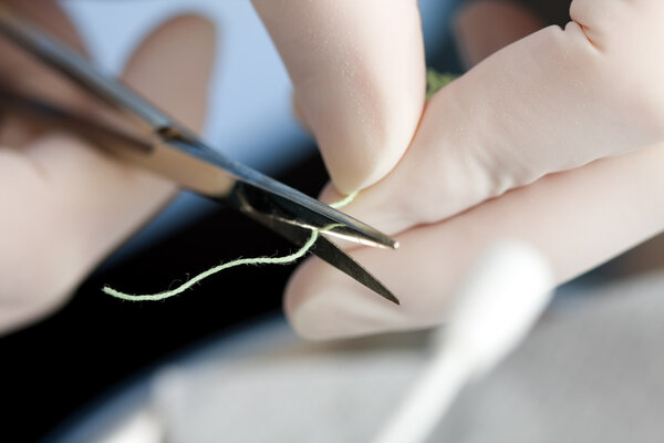 A dentist cutting a dental retraction yarn, thread. Blood and crevicular fluid can be controlled by retraction cords, that contain hemostatic agents.