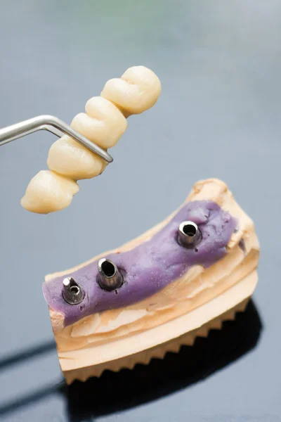Οδοντικό εμφύτευμα κεφάλι και γέφυρα — Φωτογραφία Αρχείου