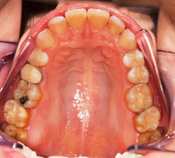 Problemas dentales — Foto de Stock