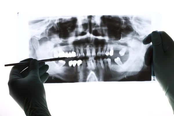 Um close-up de uma radiografia panorâmica, um dentista segurando-a na mão, apontando com uma sonda — Fotografia de Stock
