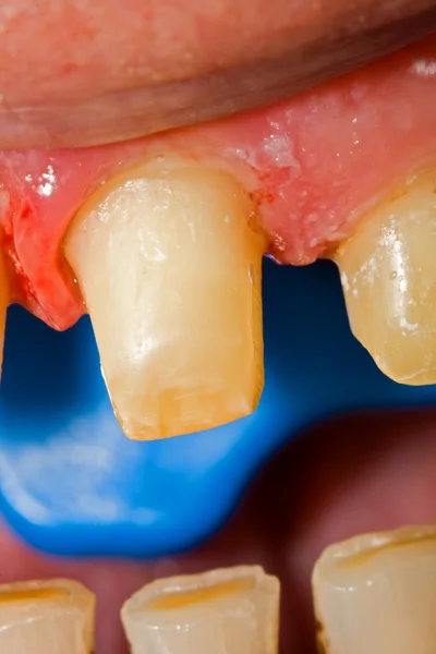 Obroušeného zuby - protetická rehabilitace — Stock fotografie