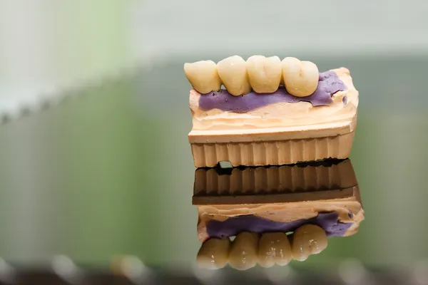 Dental bridge made of porcelain on casting — Stock Photo, Image