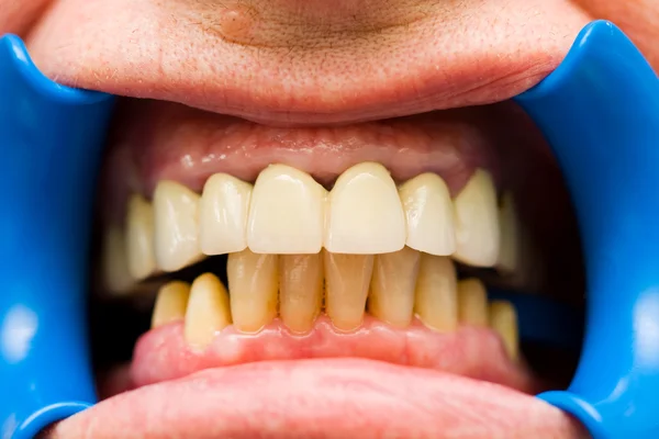 Macro shot di denti dopo lo scalpello, la protesi preparata per questo paziente è documentata nel mio portfolio dal dentista al tecnico e viceversa. . — Foto Stock