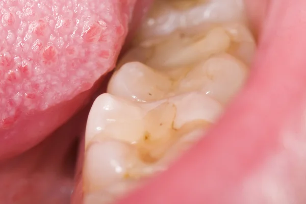 A close-up photo of a tongue and molar teeth. — Stock Photo, Image