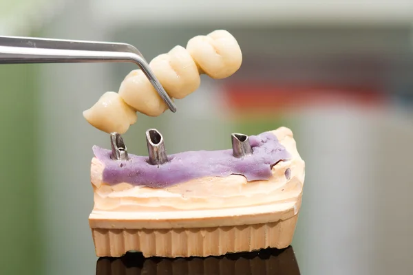 Dental implant head and bridge — Stock Photo, Image