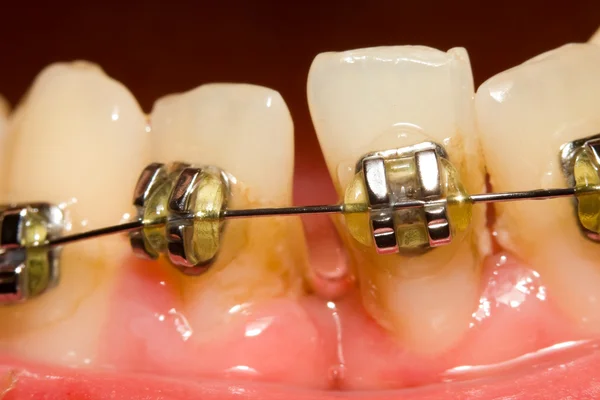 Chiusura del divario con l'apparecchio dentale — Foto Stock