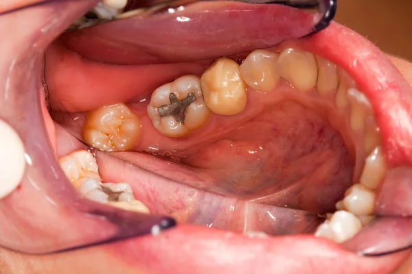Проблемы с зубами — стоковое фото