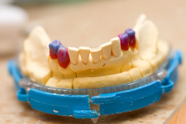 Реконструкция зубов воска — стоковое фото