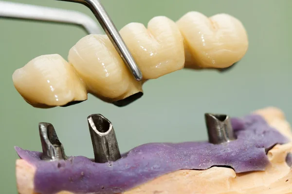 Cabeça e ponte do implante dentário — Fotografia de Stock