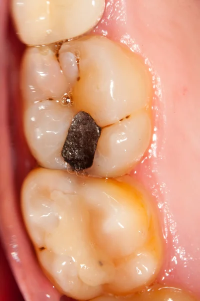 치과 문제 — 스톡 사진