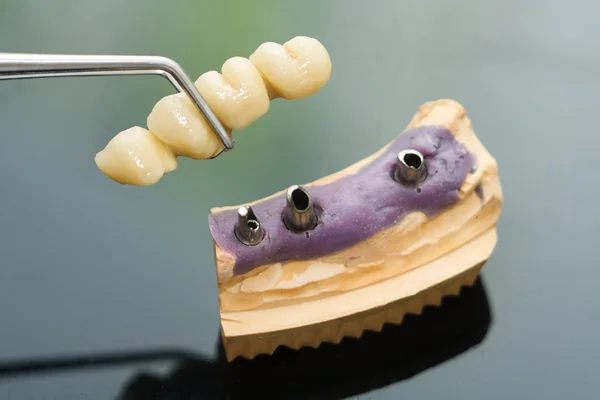 Dental implant head and bridge — Stock Photo, Image