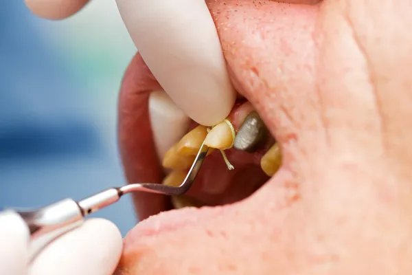 Tandheelkundige snoer plaatsen in gingival Sulcus (hersenanatomie) — Stockfoto