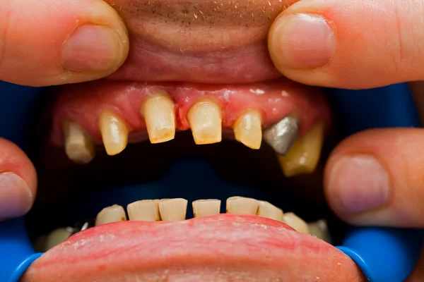 Denti lucidati - riabilitazione protesica — Foto Stock