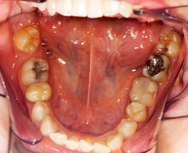 Problemas dentales — Foto de Stock