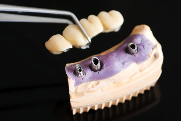 Zubní implantát hlavu a most — Stock fotografie