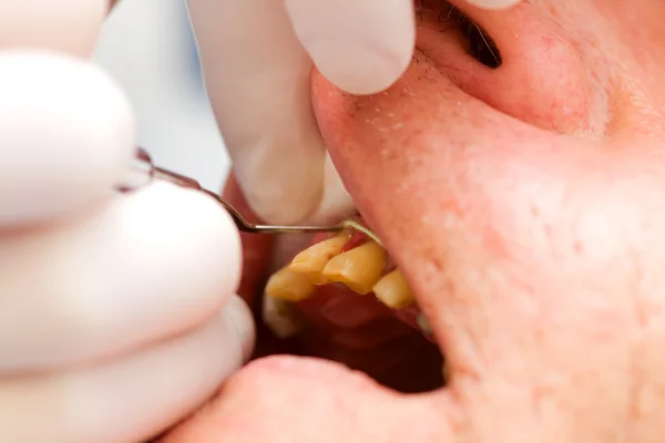 Tandheelkundige snoer plaatsen in gingival Sulcus (hersenanatomie) — Stockfoto