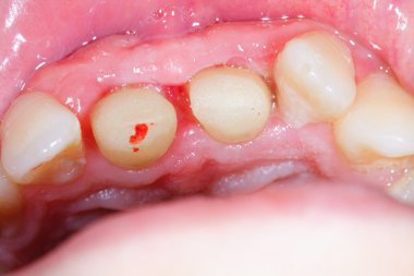 Zirkon olarak denetimli serbestlik