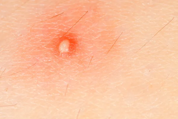 Red pimple — Stock Photo, Image