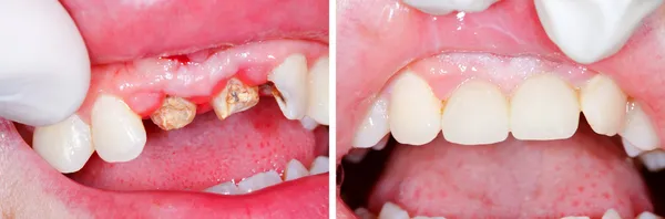 Dentes repouso raiz antes e depois do tratamento — Fotografia de Stock